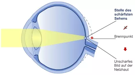 Das weitsichtige Auge