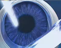 Monovision LASIK