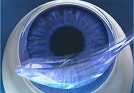 Femto-LASIK: Der Hornhaut-Flap wird aufgeklappt