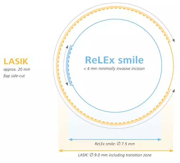 Relex Smile