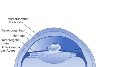 Position der Kunstlinse 