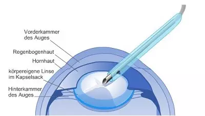 Linsenimplantation: Die Linse wird zerkleinert und abgesaugt