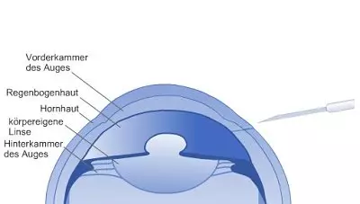 Linsenimplantation: Das Auge wird über einen Tunnelschnitt eröffnet